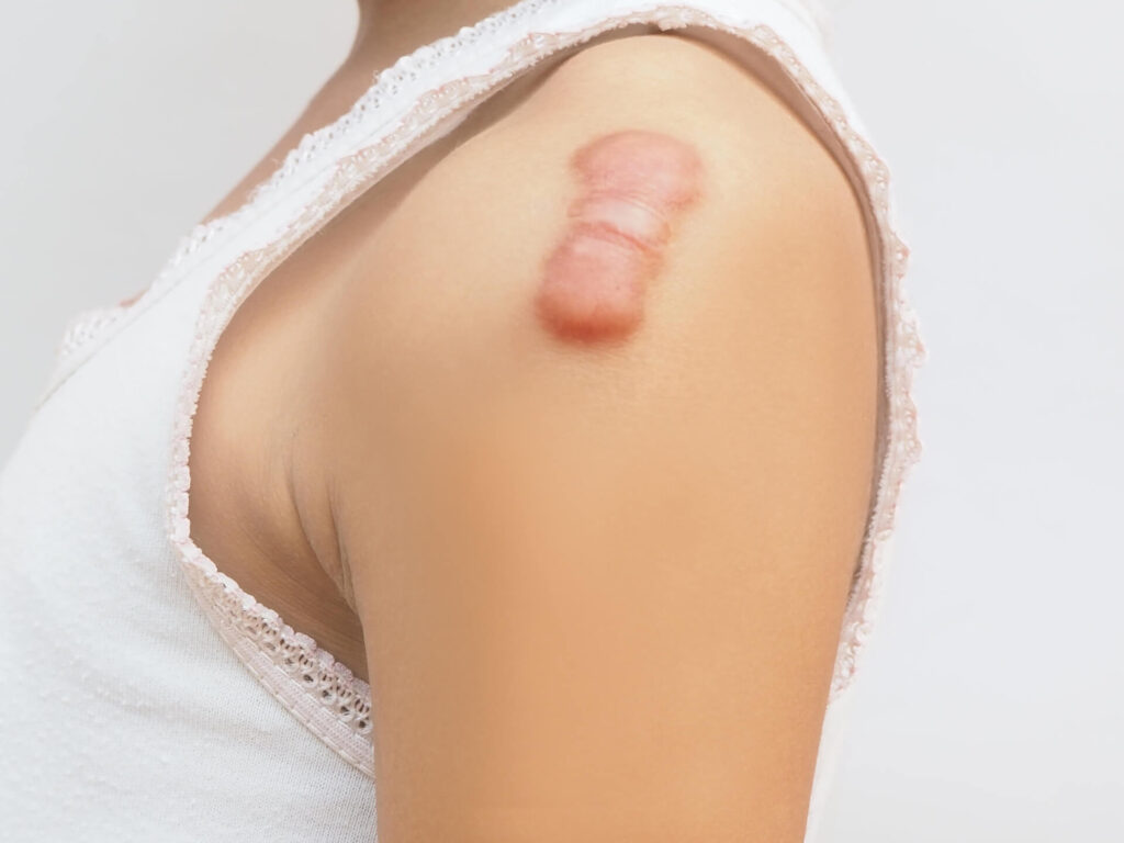 keloid-scars-on-vagina-and-how-to-get-rid-of-them